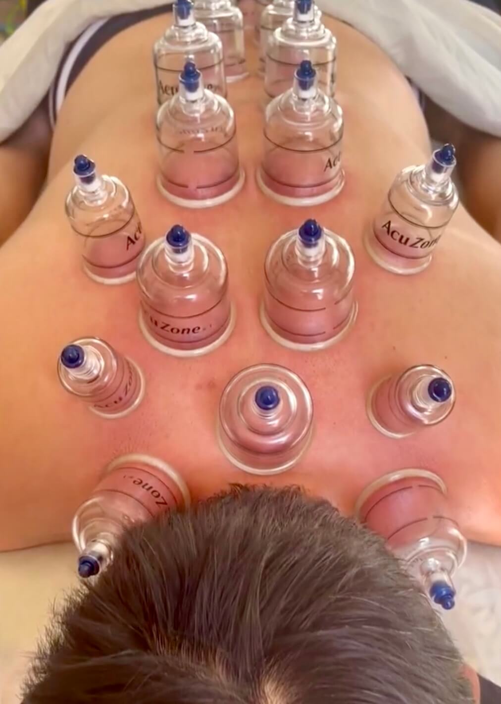 A top-down view of a male client receiving traditional cupping therapy with several clear AcuZone suction cups placed on his back.